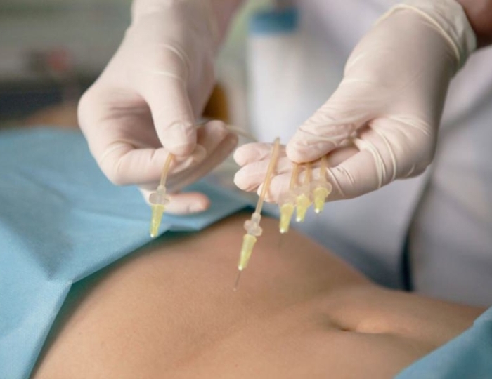 Озонотерапия - Санаторий «Пикет» Кисловодск